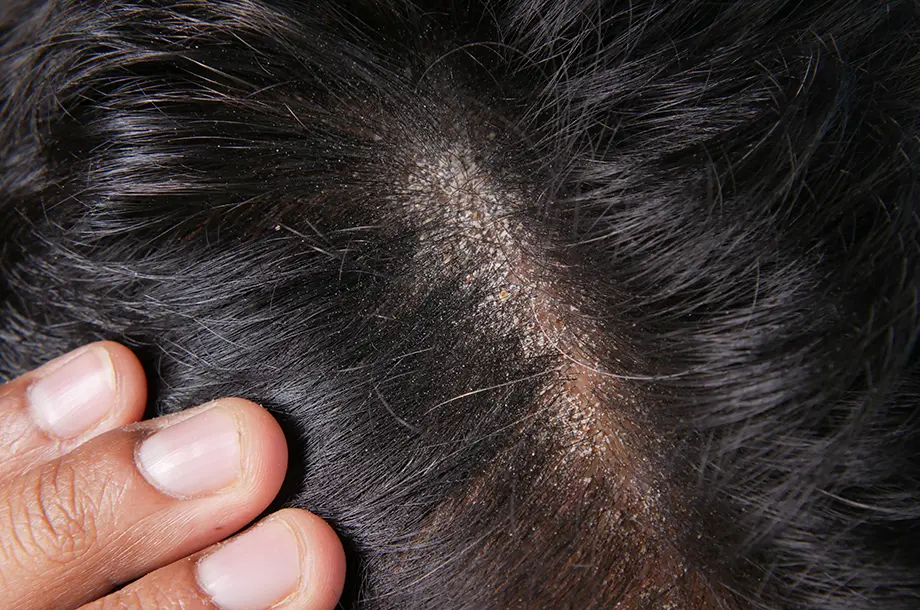 Zoom sur un crâne avec de l'Eczéma